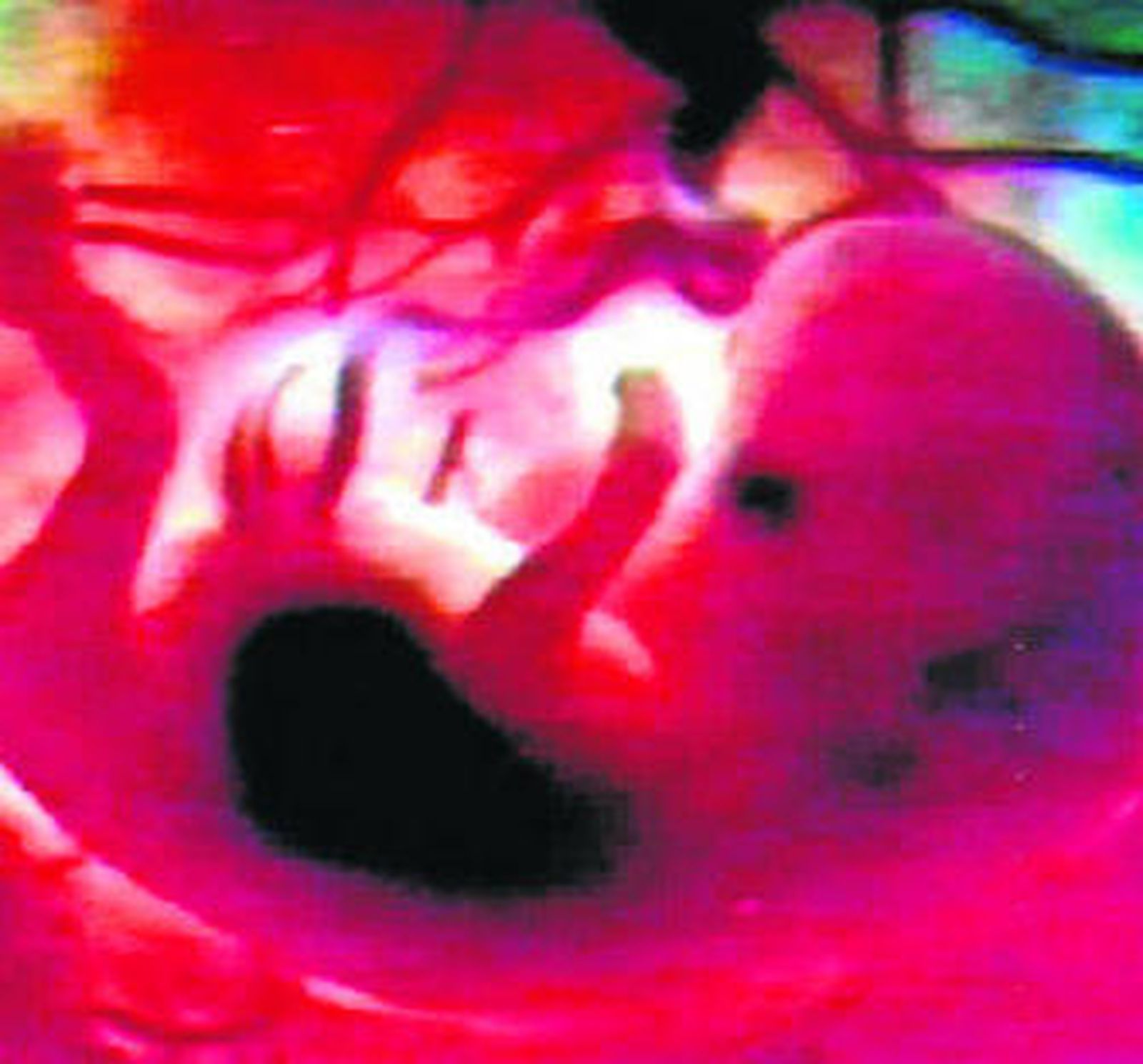 En los primeros meses el feto precisa de la hormona tiroidea de la madre.