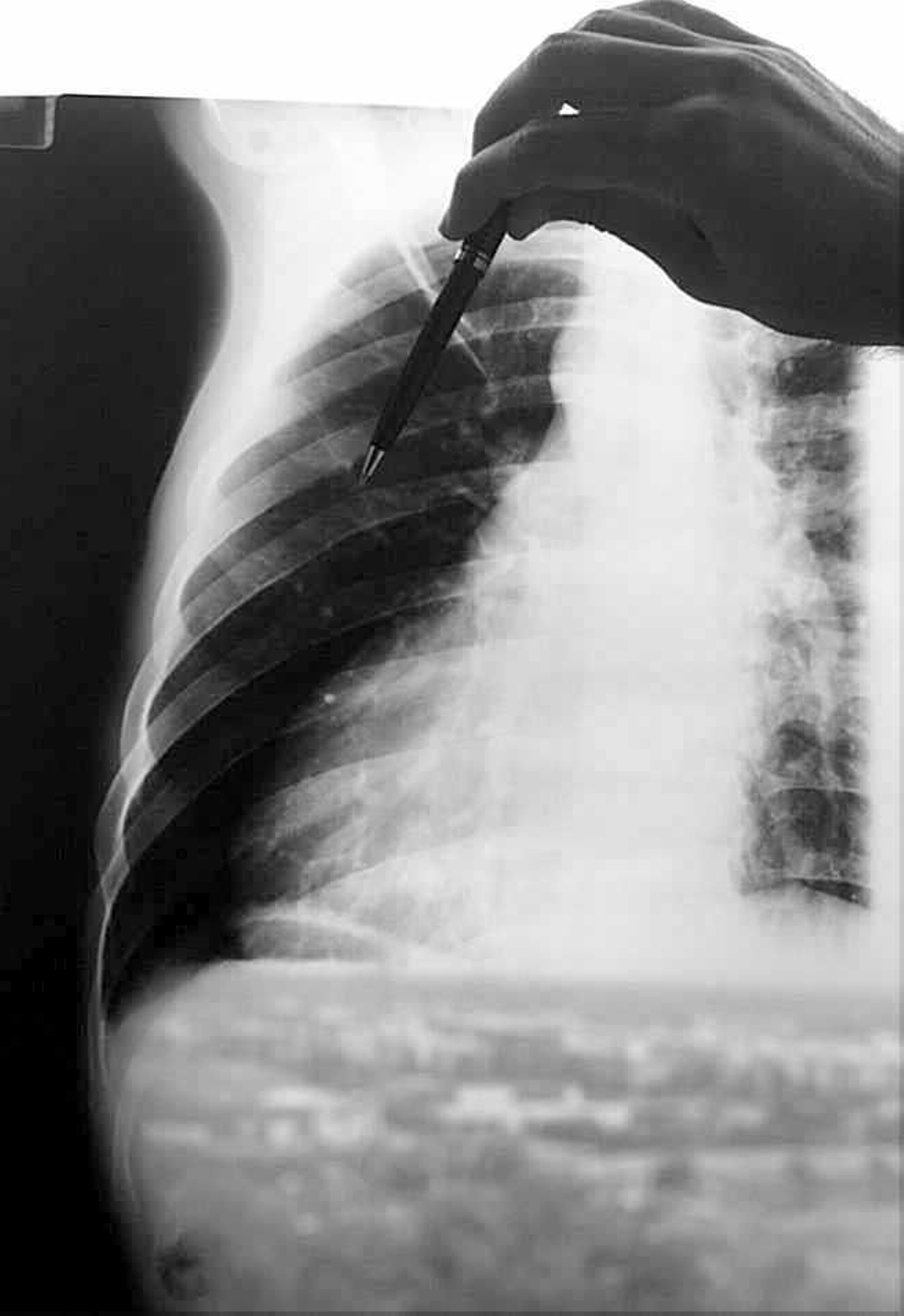 Examen de una radiografía de tórax.