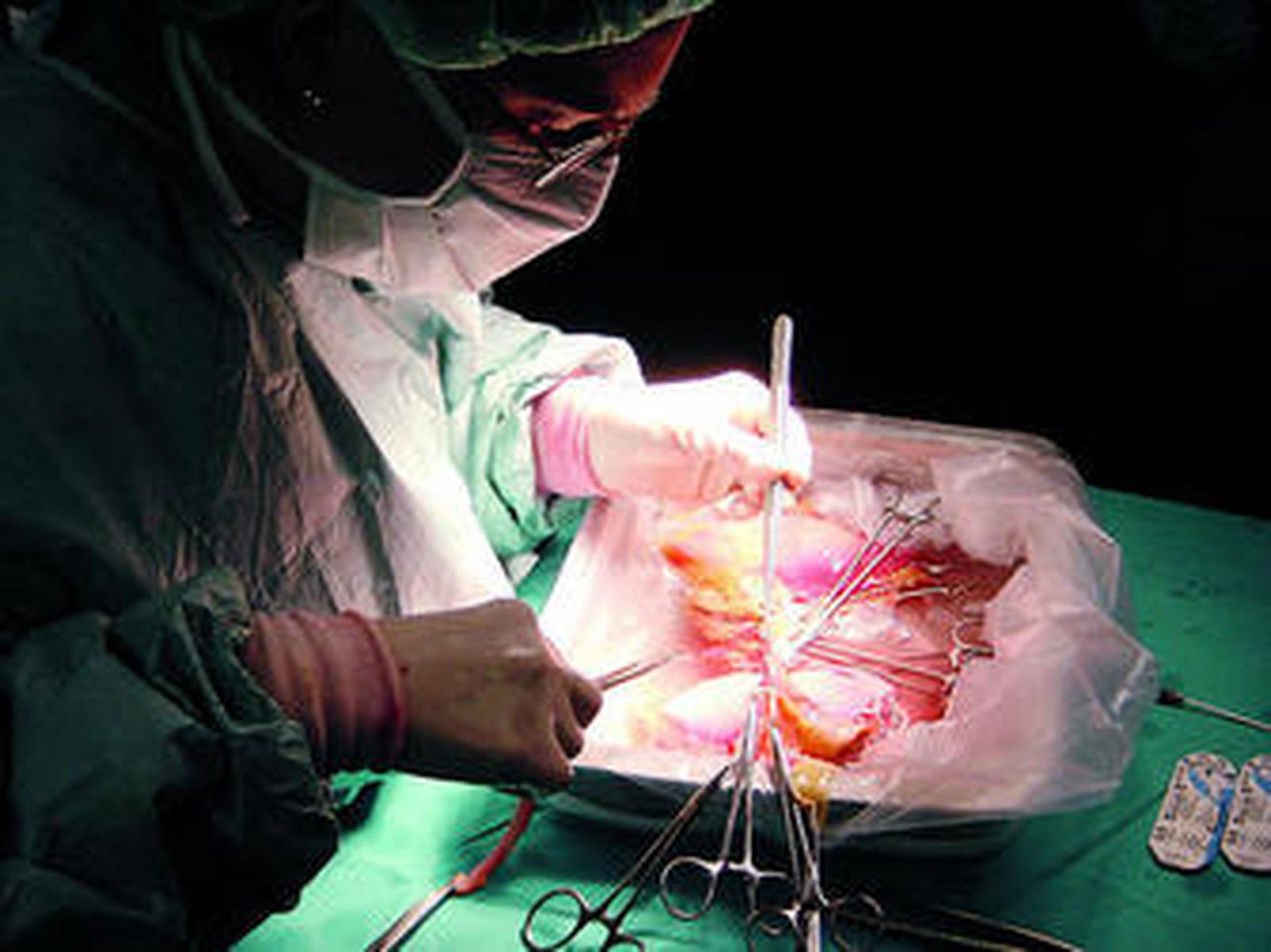 Un cardiólogo realiza una operación de corazón en un quirófano.