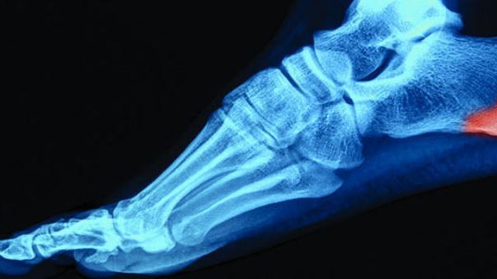 Radiografía de un espolón calcáneo.