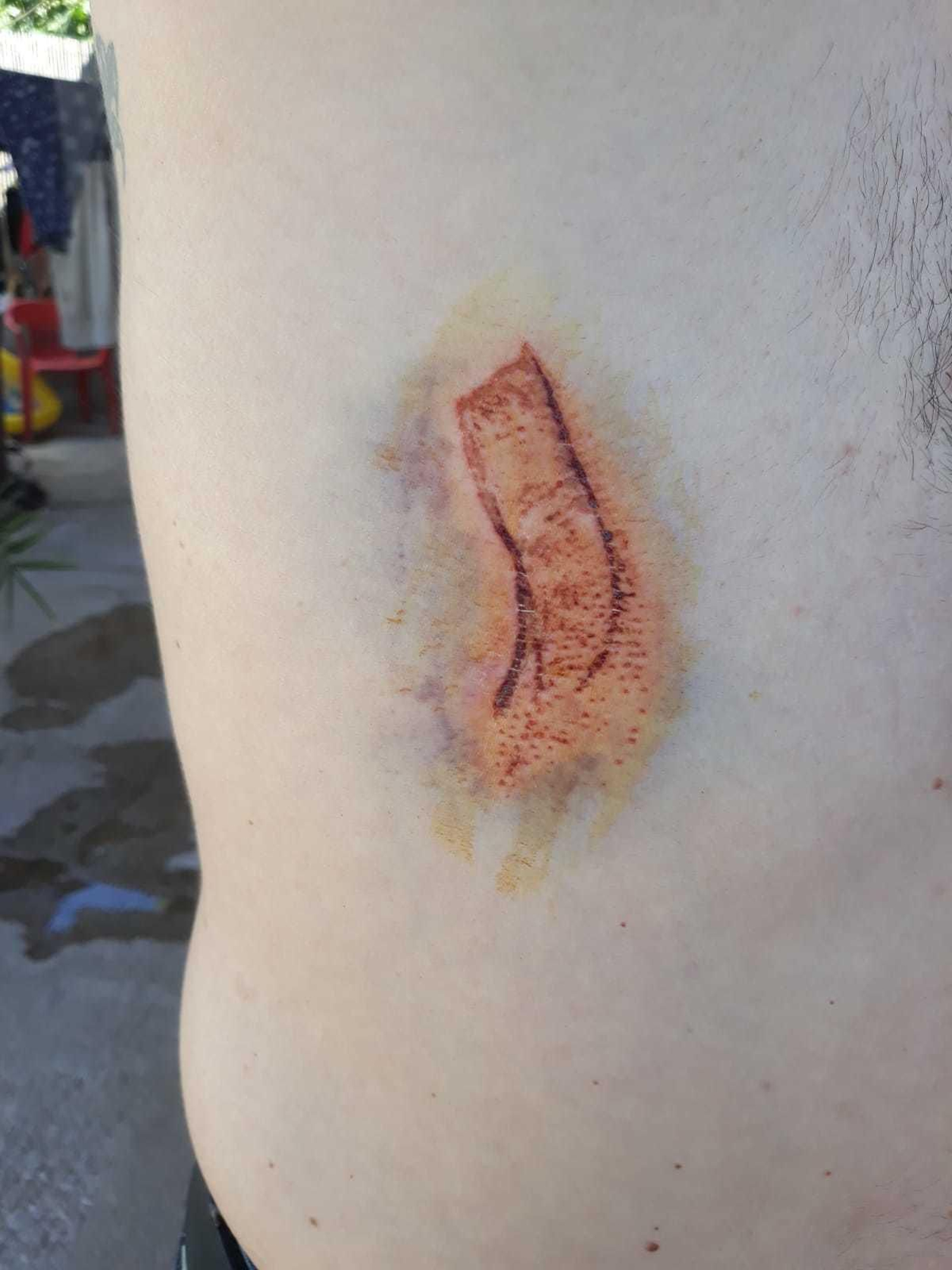 Herida en la espalda.