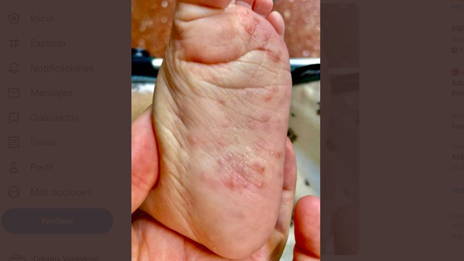 Un caso de sarna diagnosticado en un niño en la consulta del doctor Conejo-Mir.