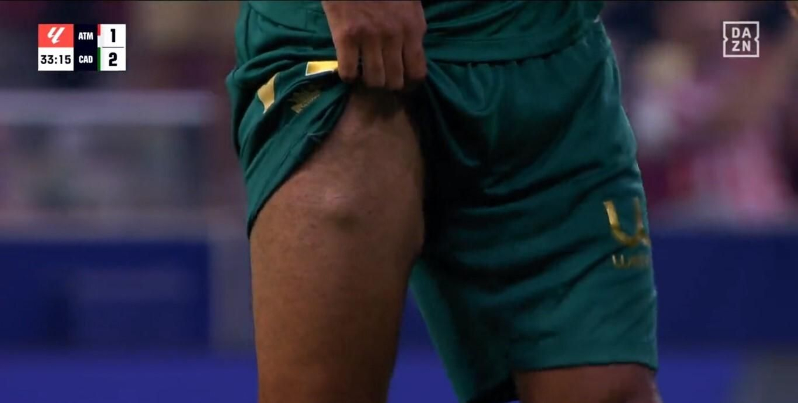 Los bultos que tiene Fali en su muslo.