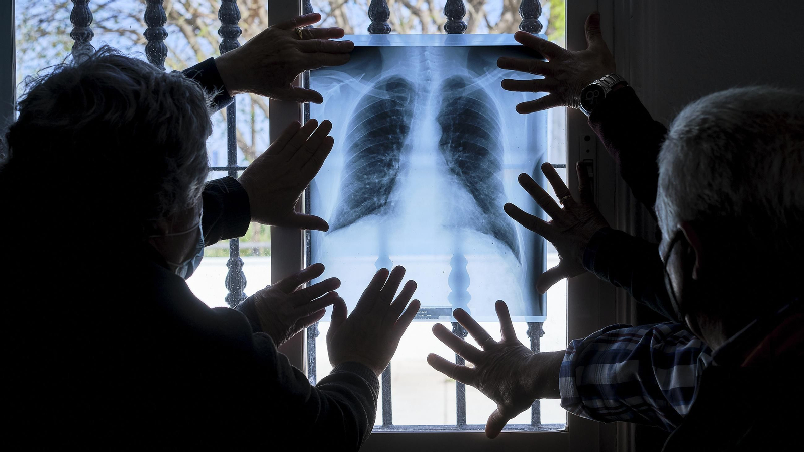 Una radiografía de un afectado por el amianto.