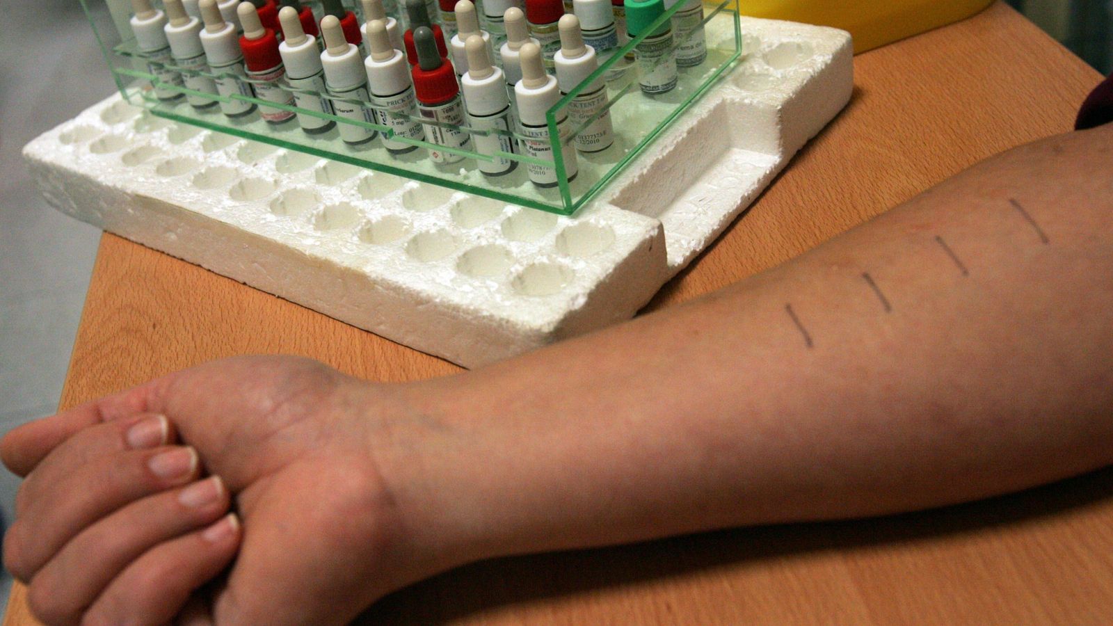 Pruebas de la alergia.