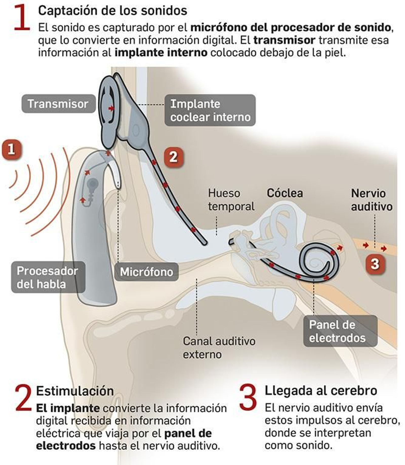 Cómo funciona un implante coclear Cómo funciona un implante coclear