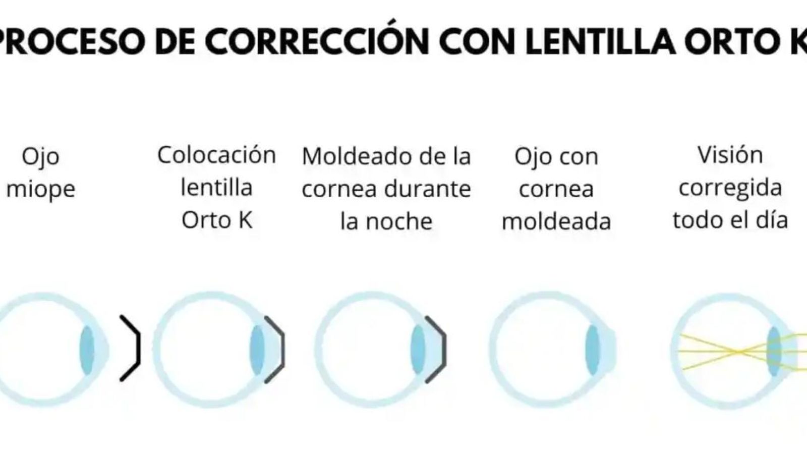 Proceso de corrección ORTO-K