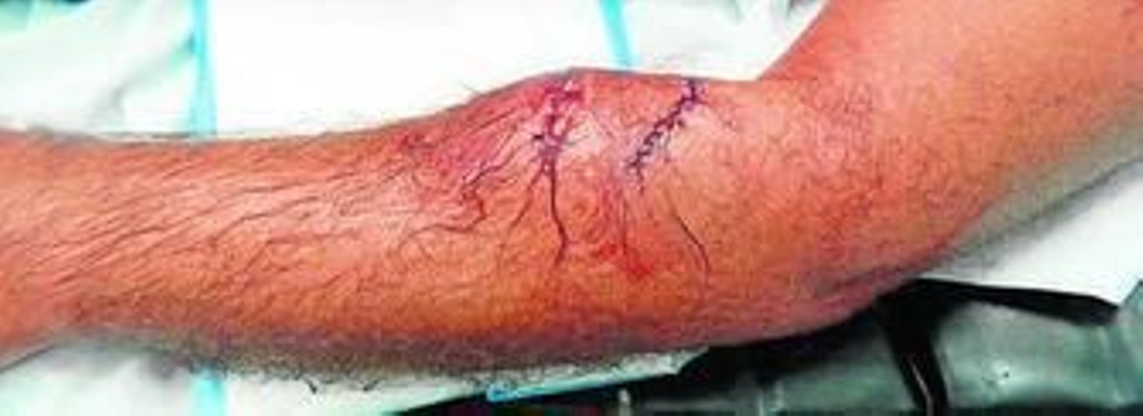 Imagen del brazo de la víctima tras ser curado de las mordeduras.