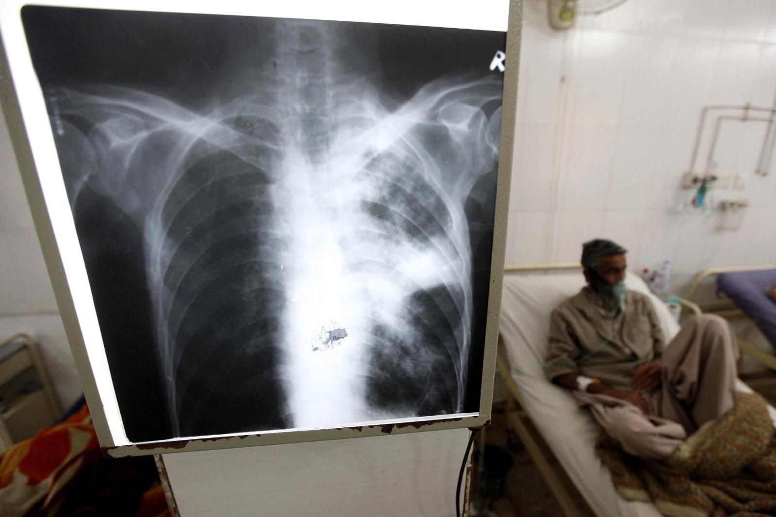 Un enfermo de tuberculosis reciben atención médica.