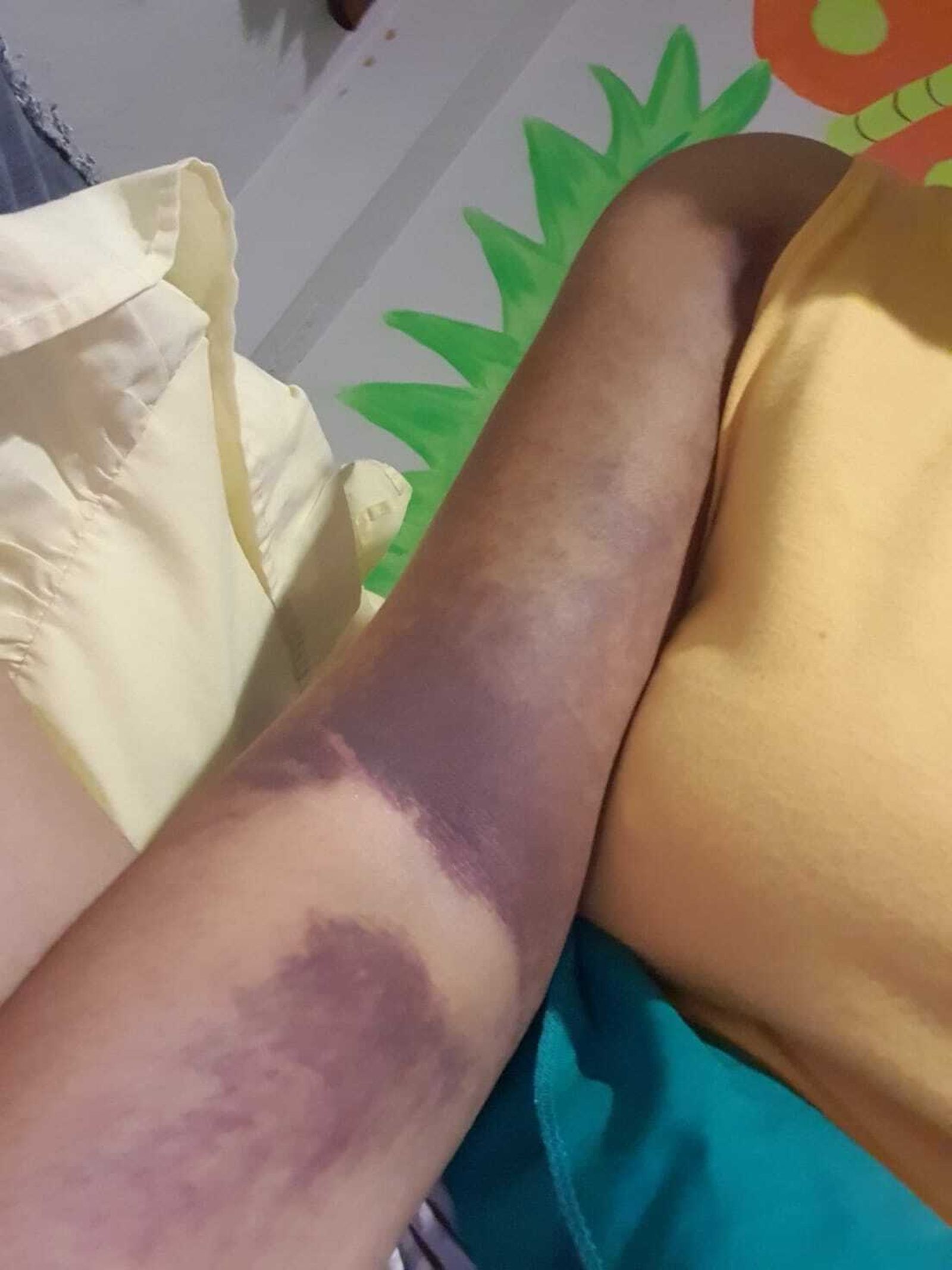 El brazo de la mujer que ha denunciado un robo con violencia en Marbella