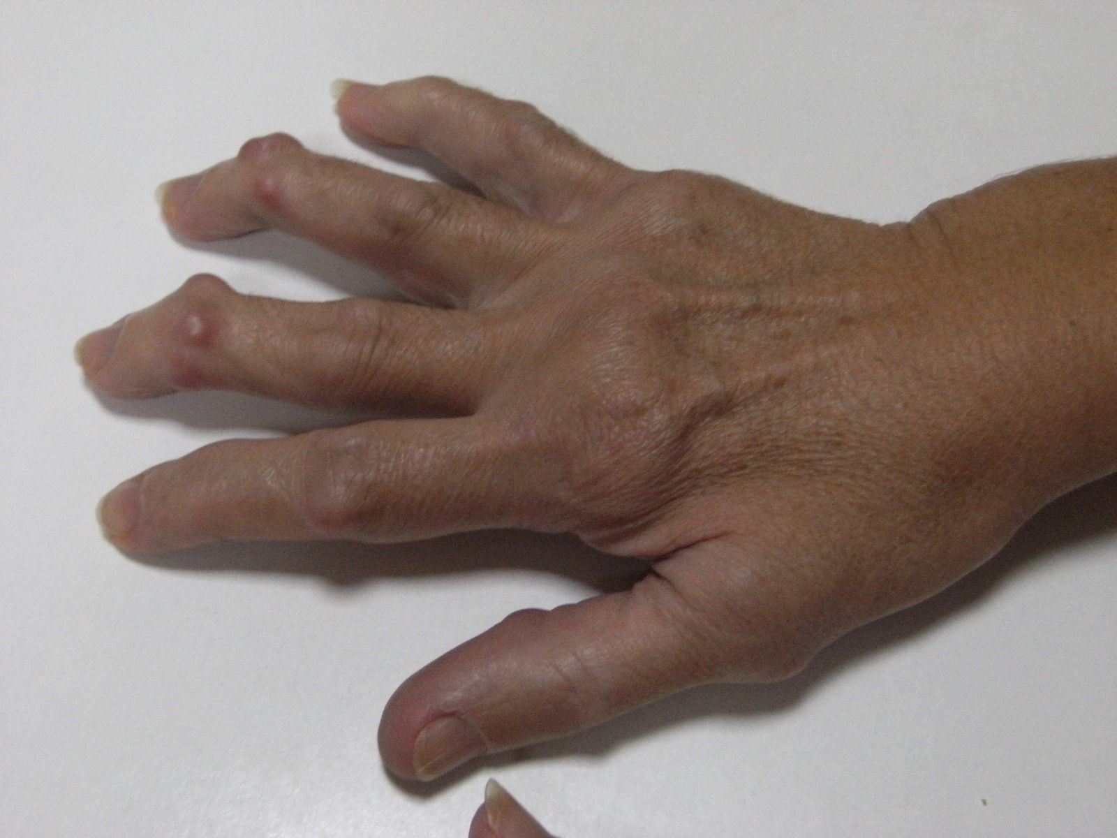 La mano de una mujer, deformada por la artritis reumatoide.