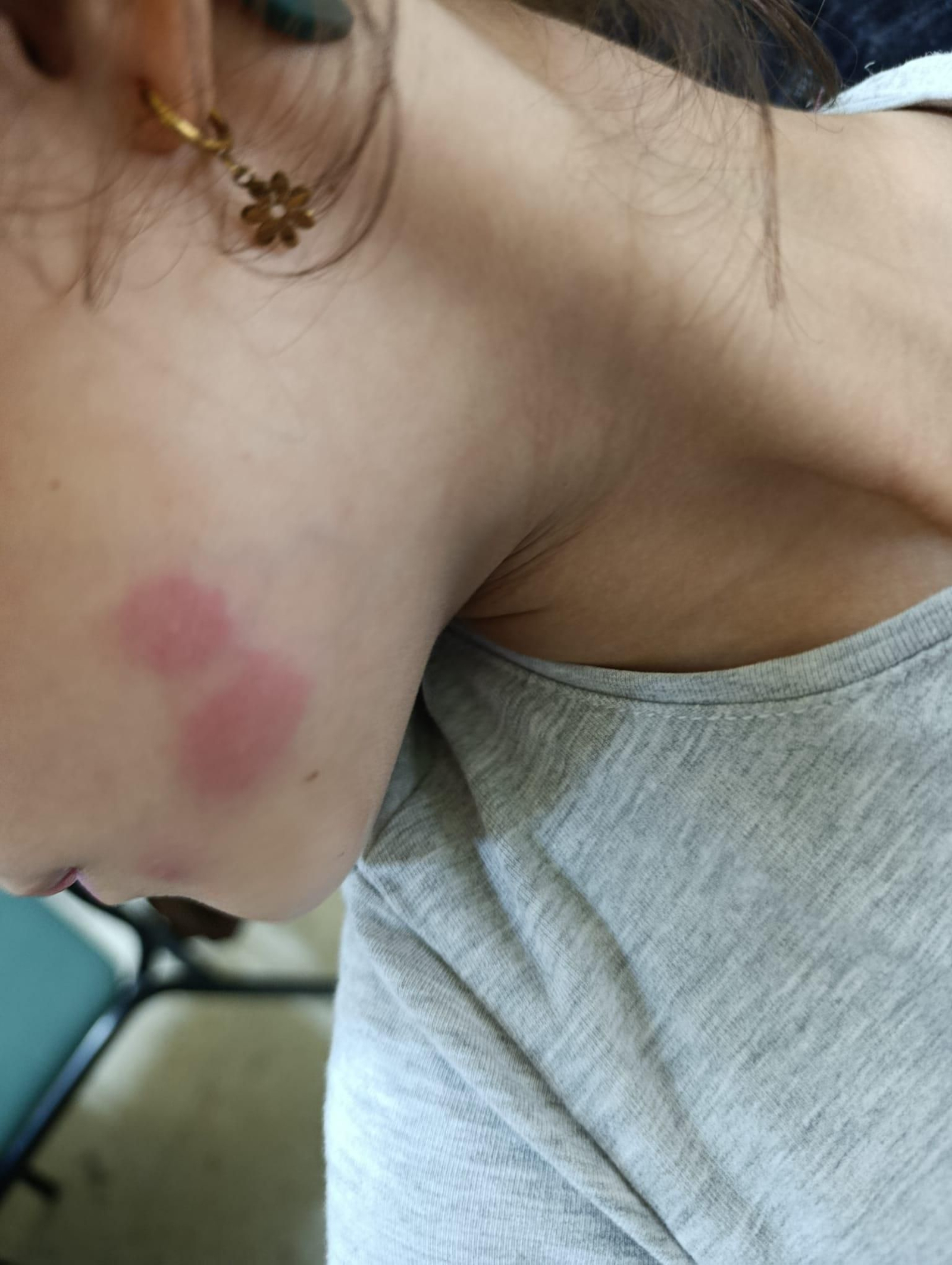 Las picaduras de insectos en la cara de una escolar.