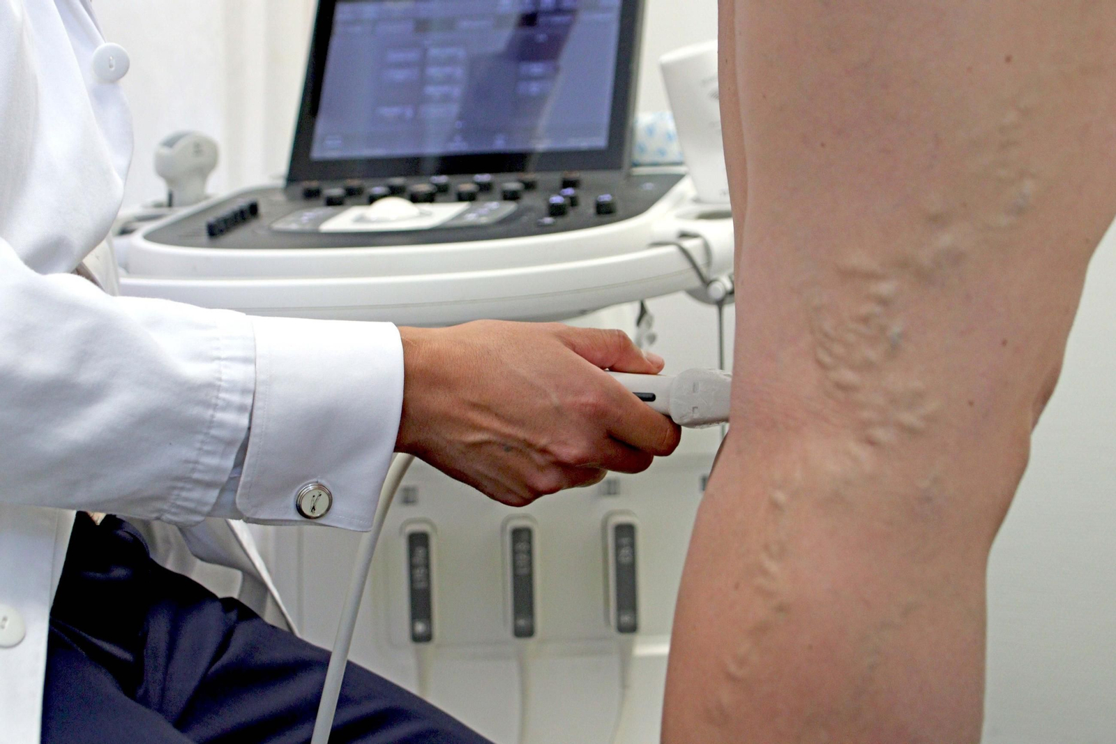 Un médico atiende a un paciente con varices.