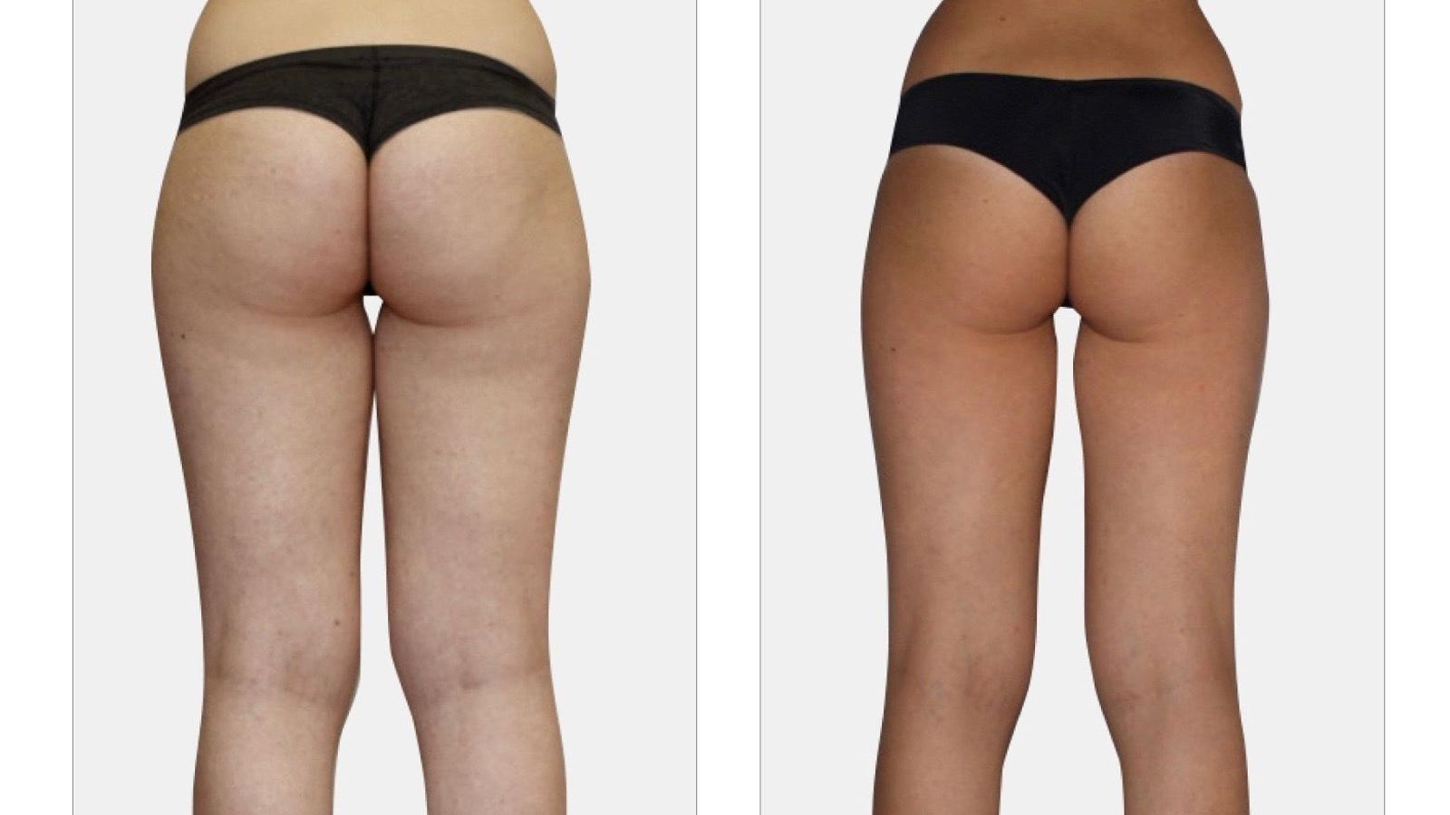 Resultados después de realizarse el tratamiento LPG endermologie que aplican en los centros de belleza Hedonai.