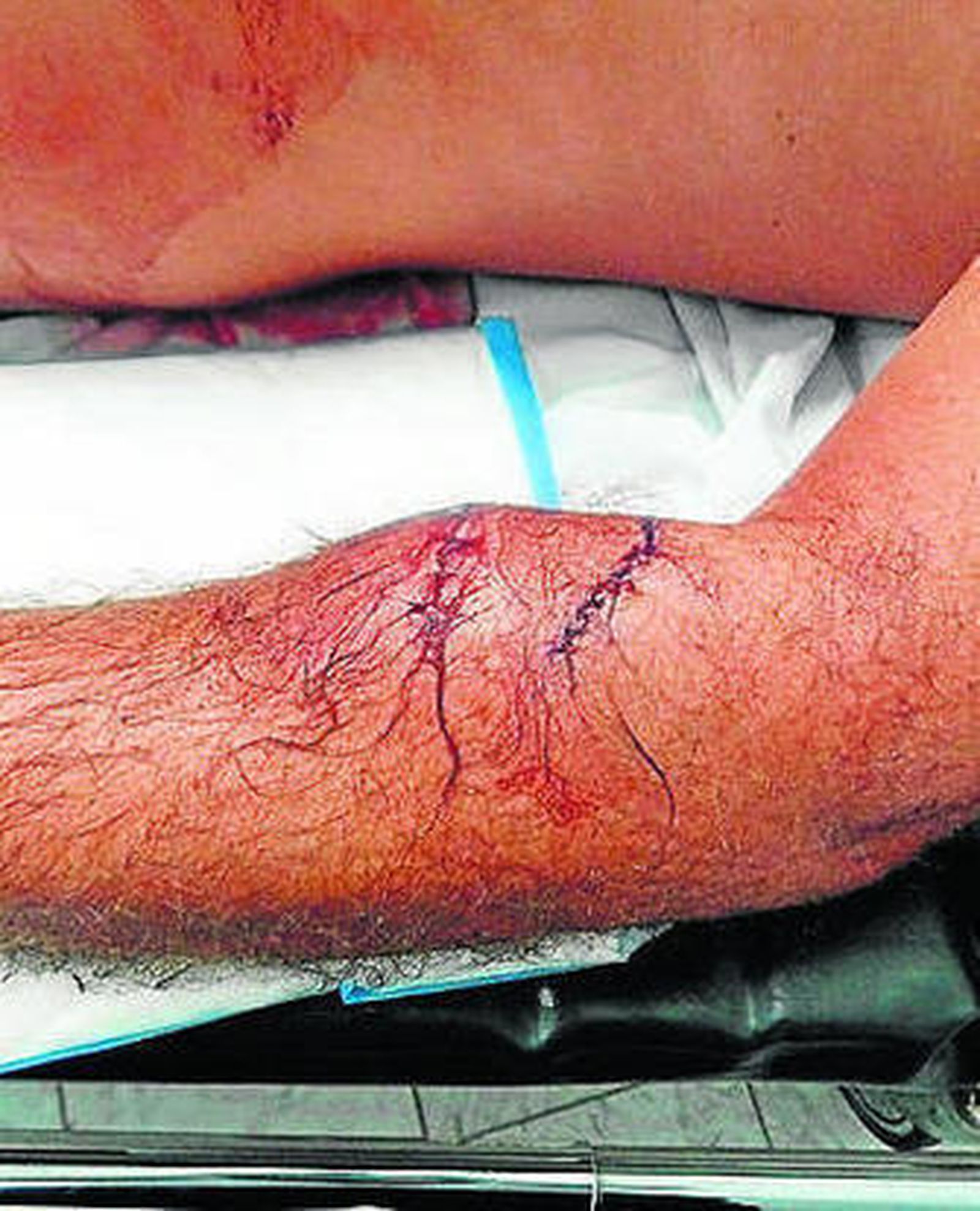 El brazo herido de Gravenell.