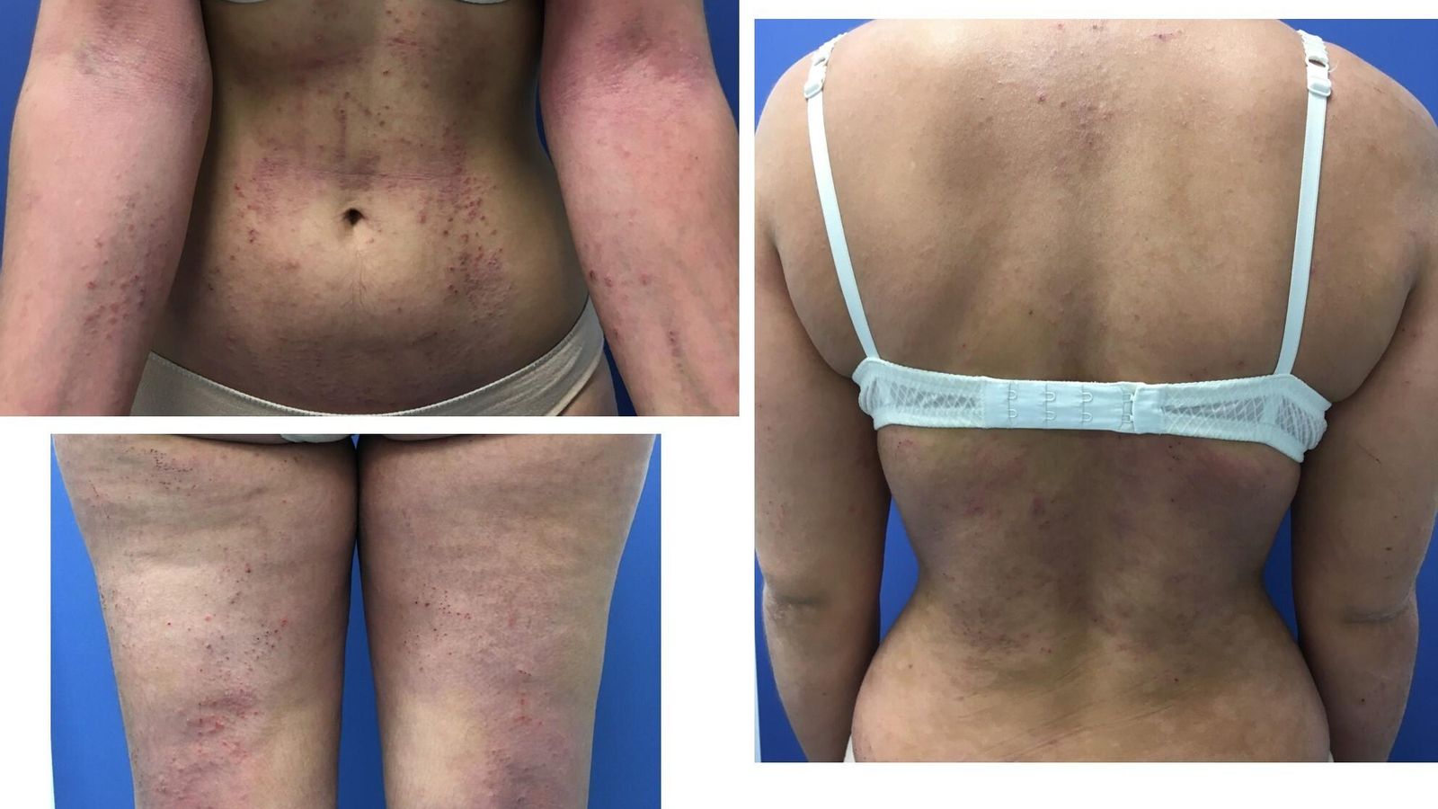 Estado de la piel de una mujer adulta afectada durante un brote de dermatitis atópica con manifestaciones en la mayor parte del torso y las piernas.