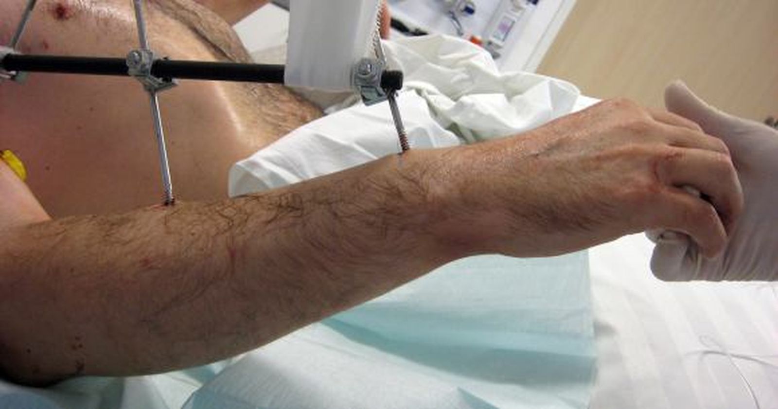 Médicos alemanes logran el primer trasplante completo de dos brazos