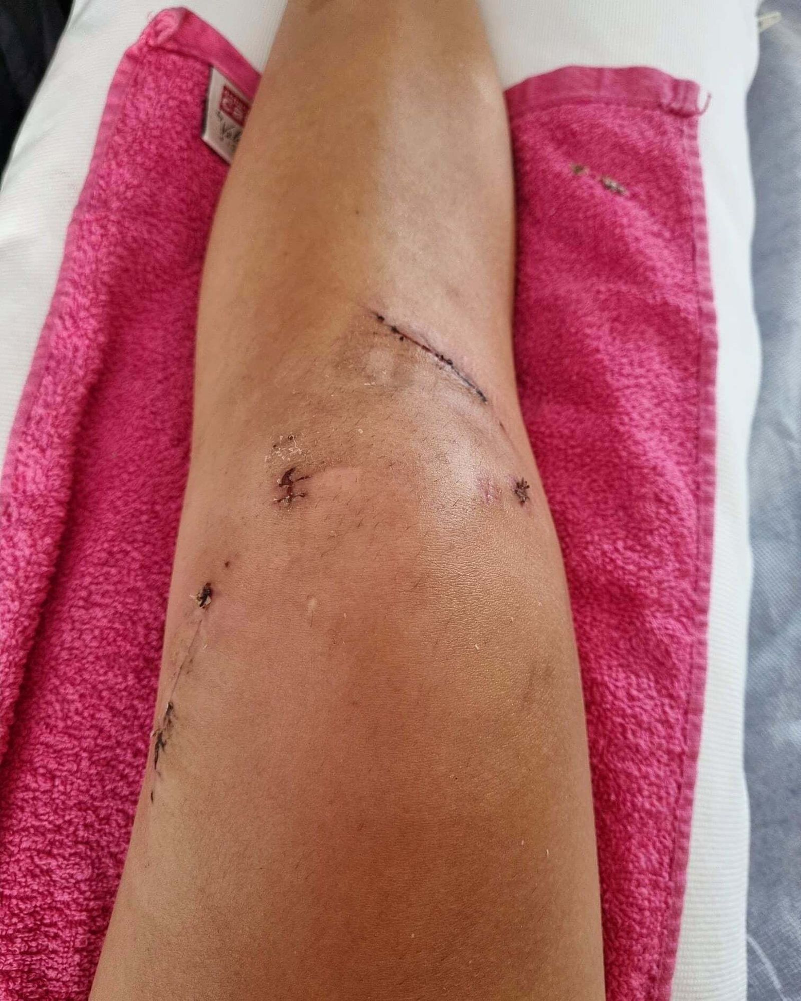 La rodilla recién operada de Carolina Marín