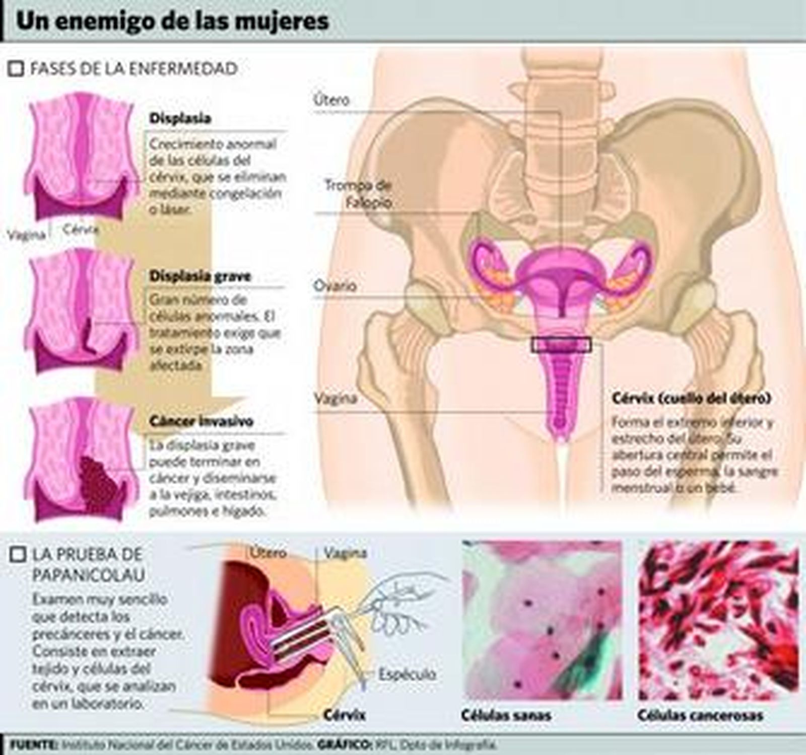 La vacuna contra el cáncer de cérvix se aplicará desde septiembre