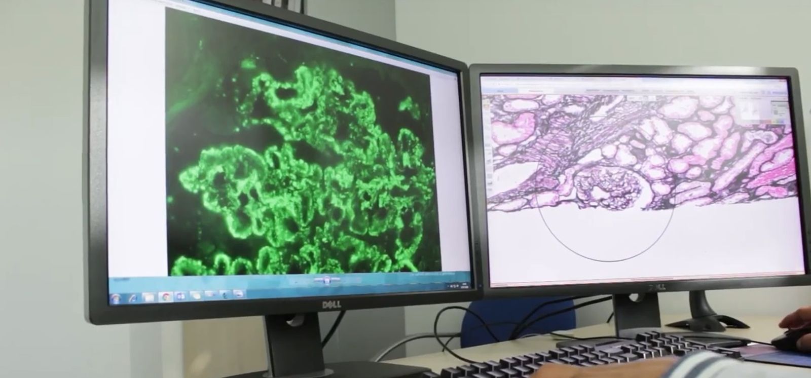 Imágenes de anatomía patológica digitalizadas por el grupo Quirónsalud.