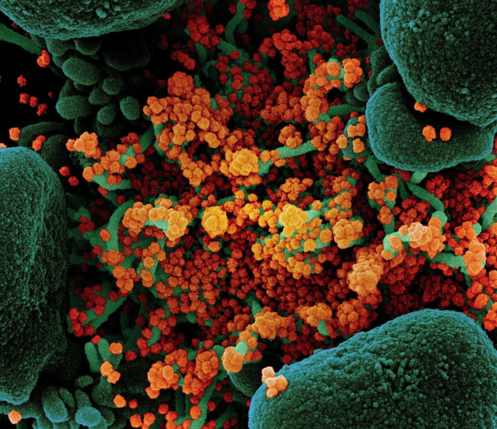 Imagen coloreada tomada por un microscopio electrónico de una célula en apoptosis (verde) gravemente infectada por el virus  SARS-COV-2 (naranja).