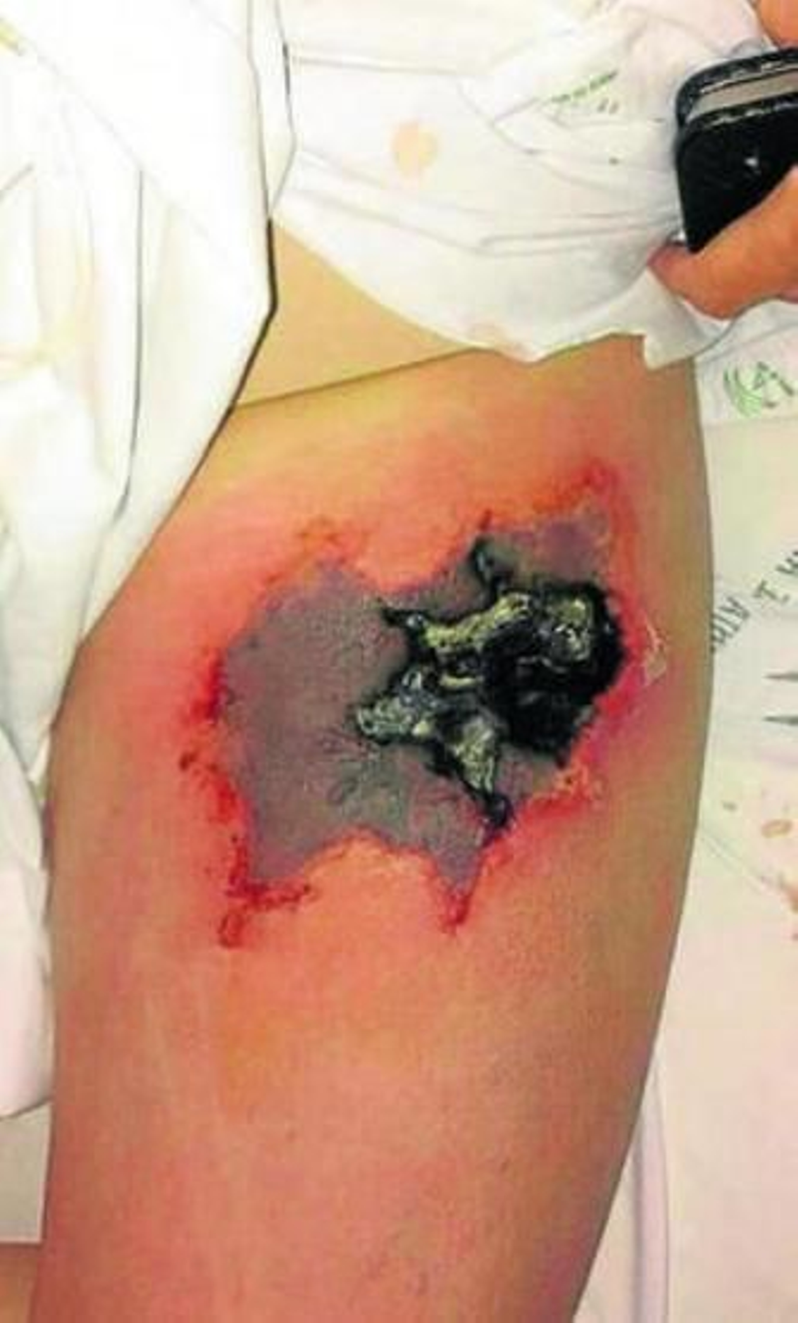 El hospital atiende otra necrosis pero la Junta sigue negando la plaga de arañas