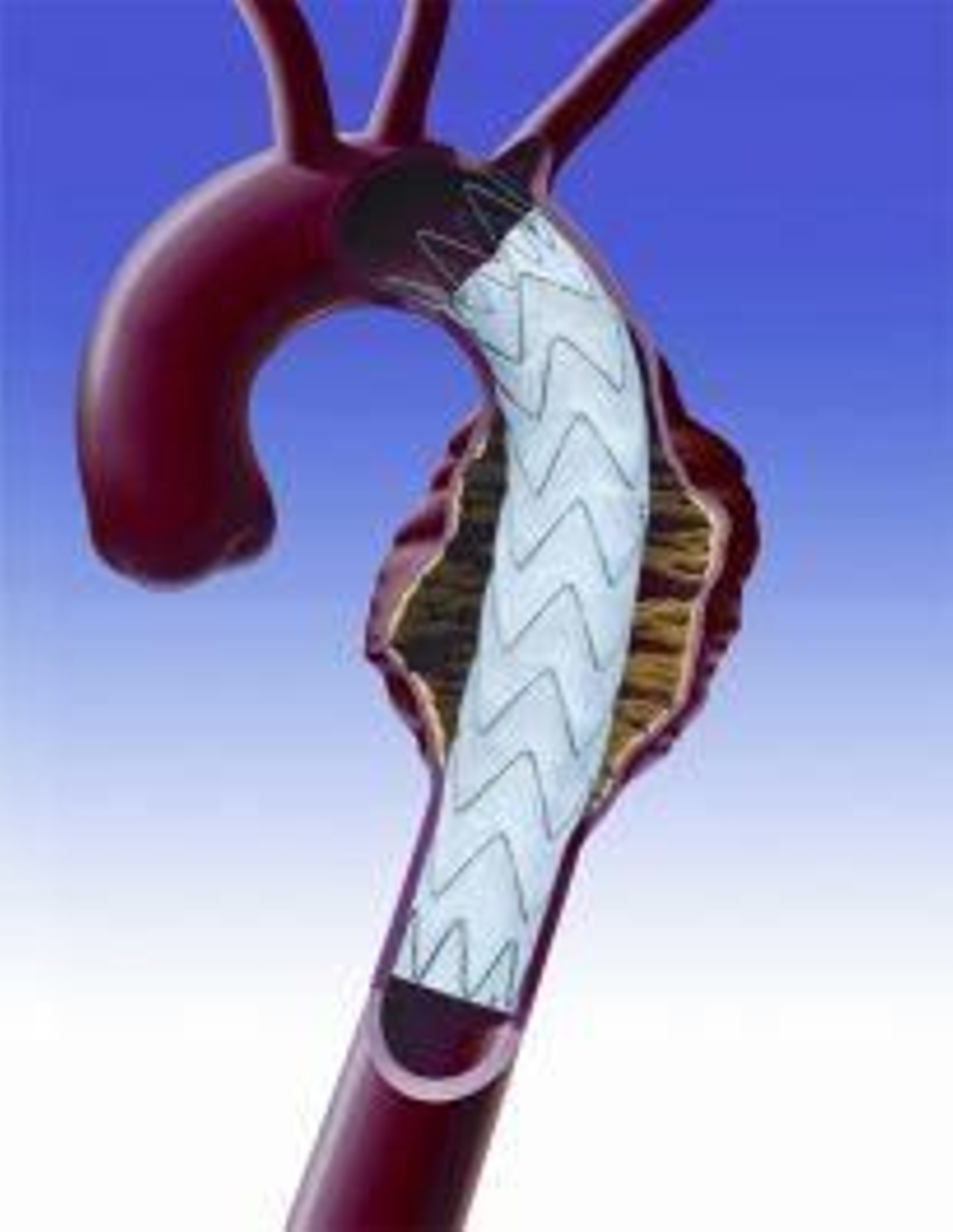 Imagen de cómo actúa la prótesis.