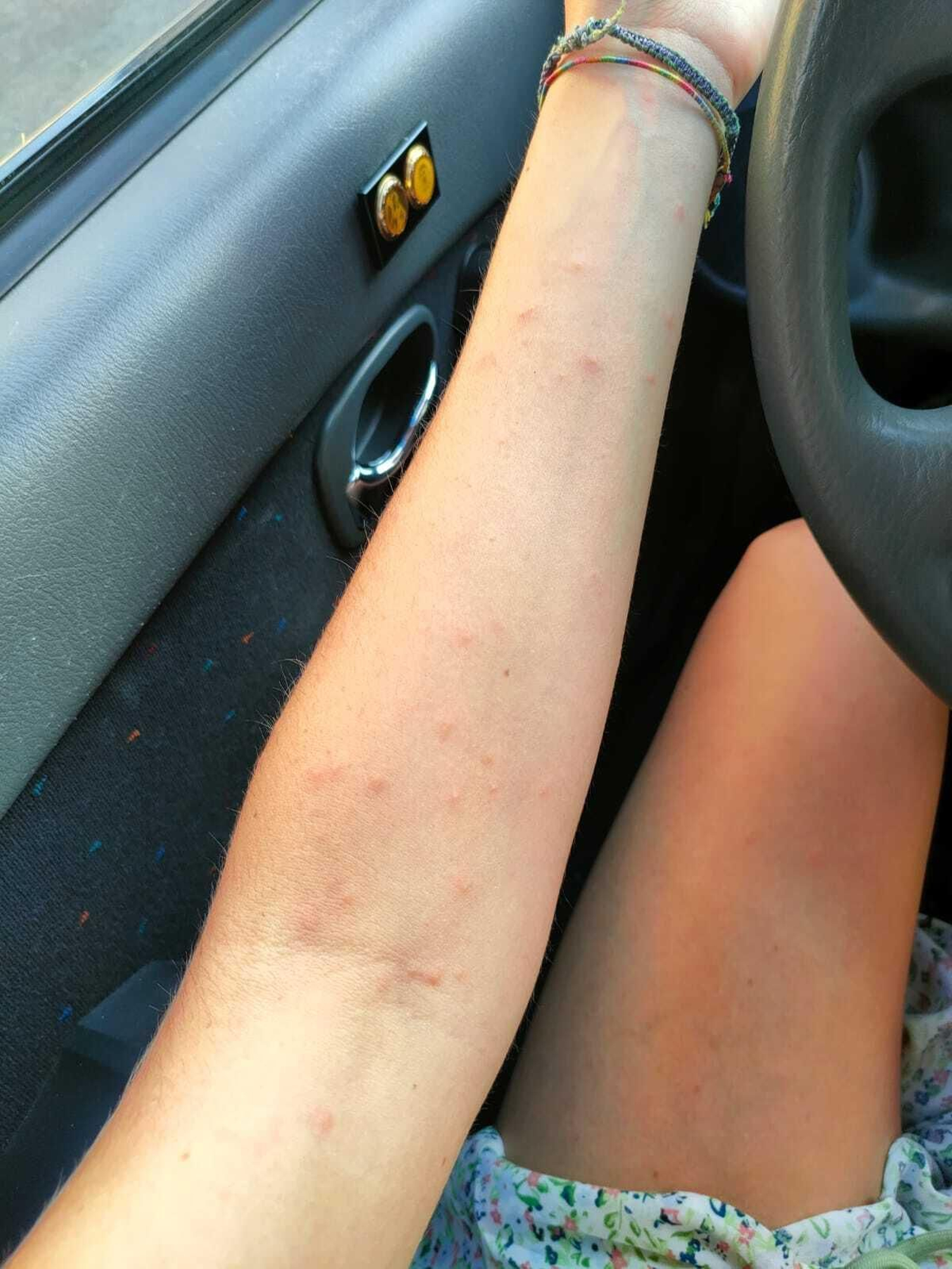 Picaduras en un brazo.