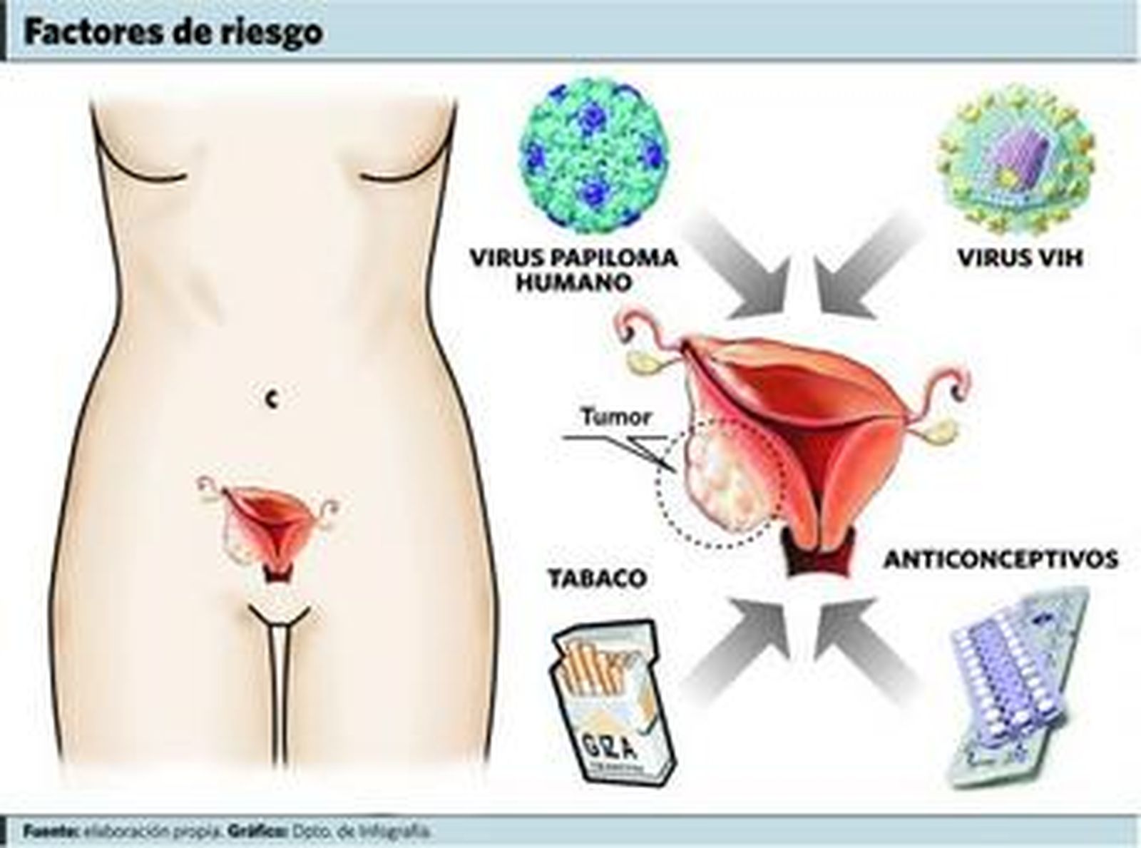 La presencia del virus del papiloma es imprescindible para el tumor