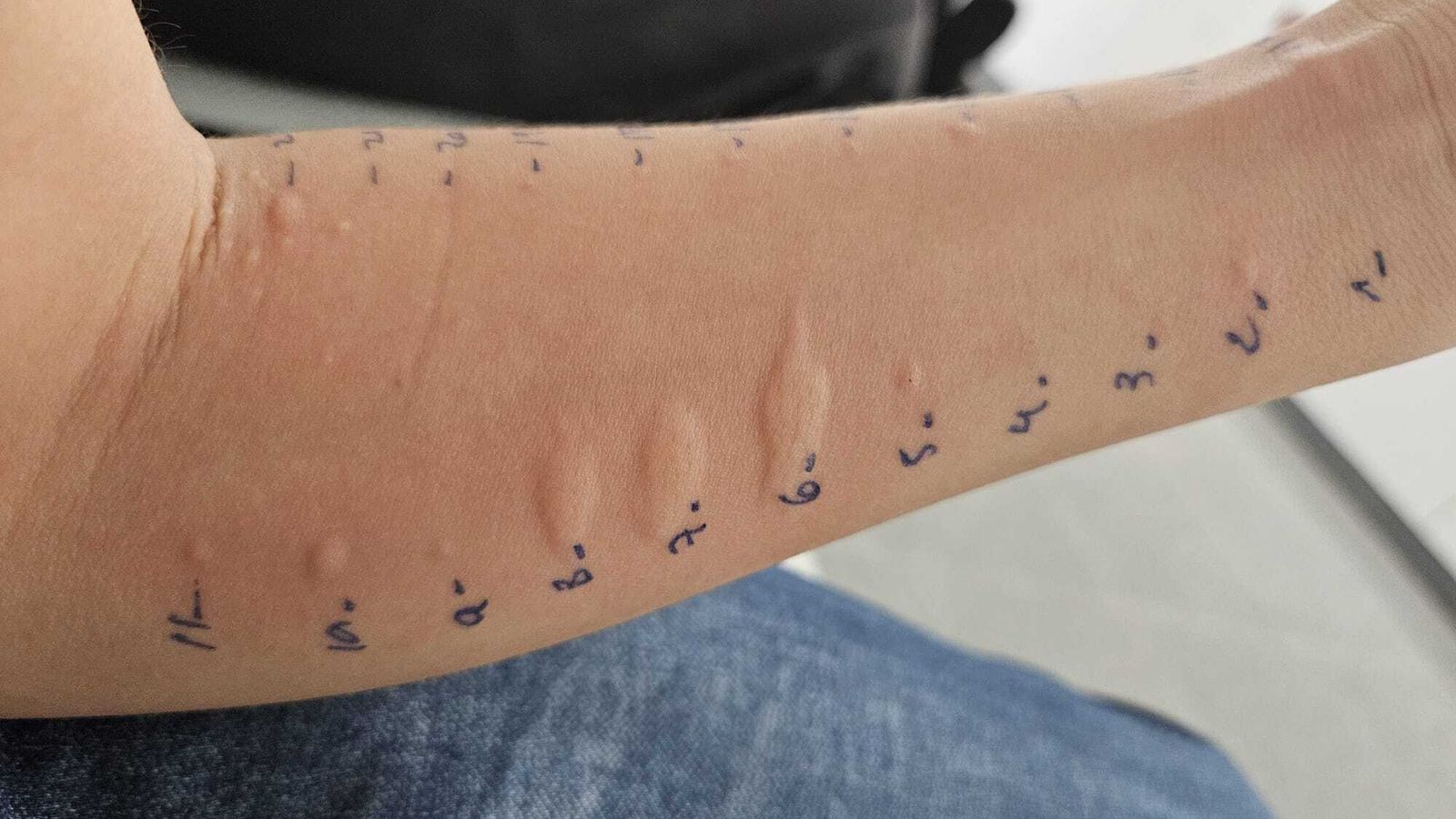 Reacción de la prueba cutánea realizada a un menor de ocho años en la consulta del Hospital Materno Infantil de Almería