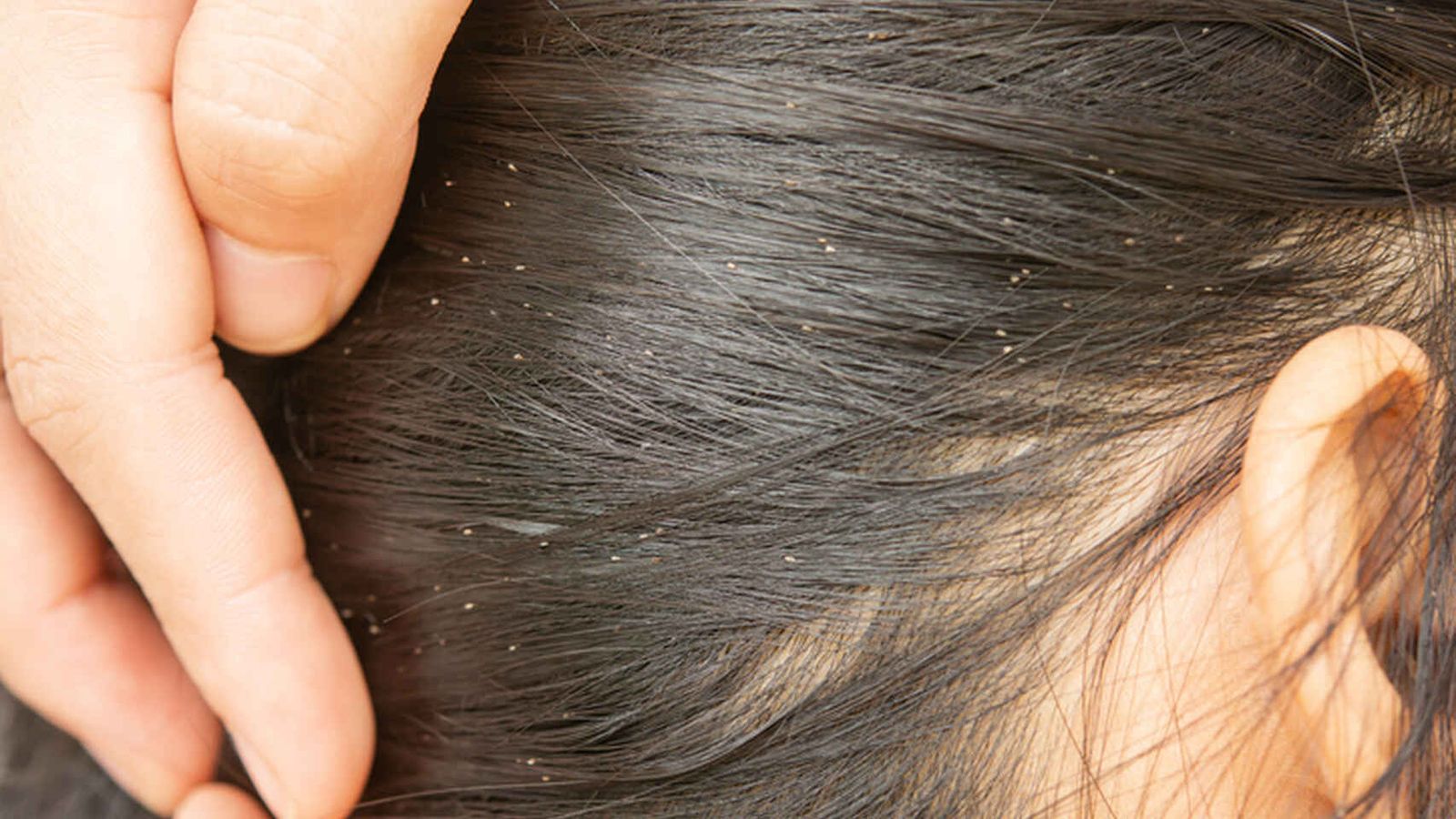 Una cabeza infantil plagada de liendres.