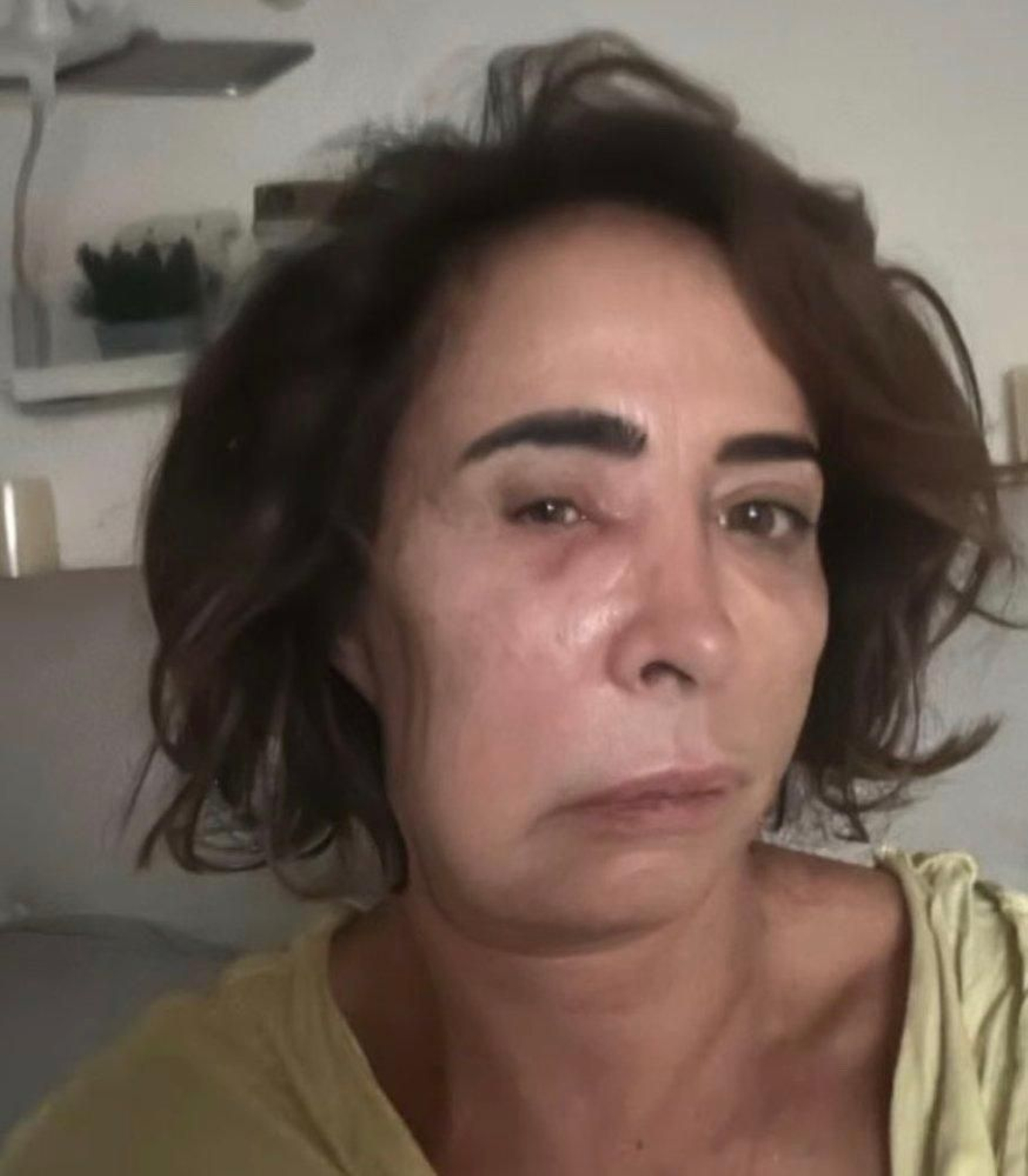 El rostro actual de María Patiño por culpa de un flemón.