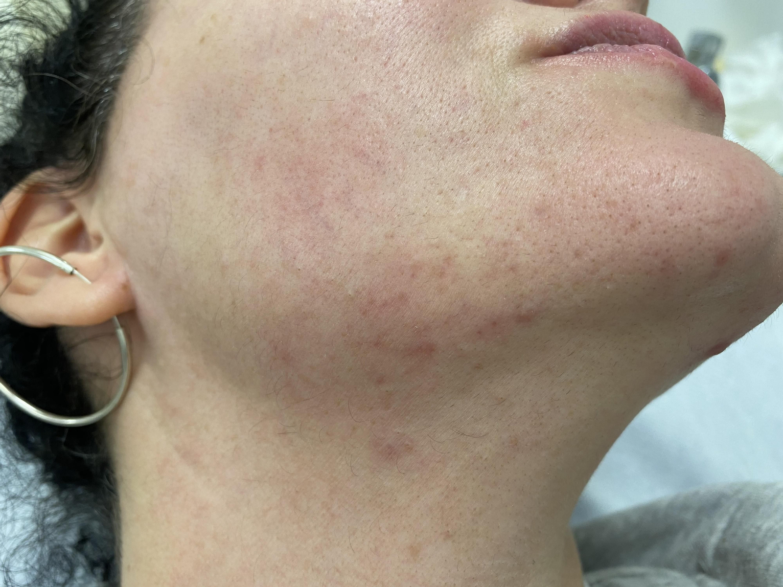 Apreciación del Maskné, dermatitis facial por efecto de la mascarilla.