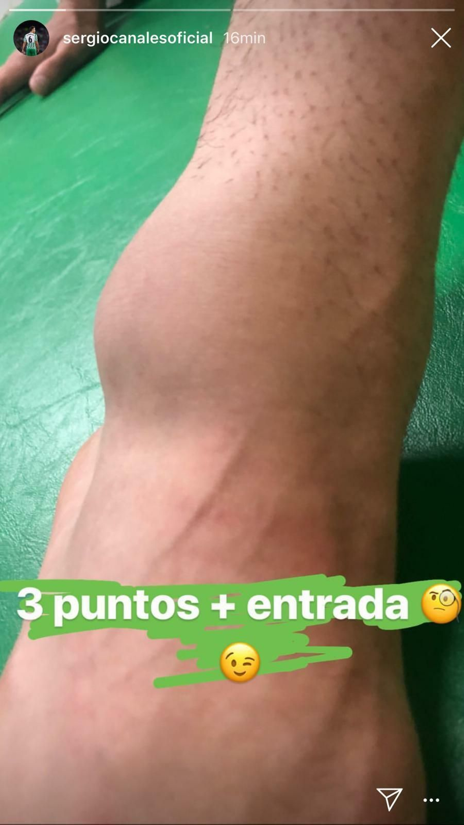 La imagen que ha subido Canales de su tobillo dañado.