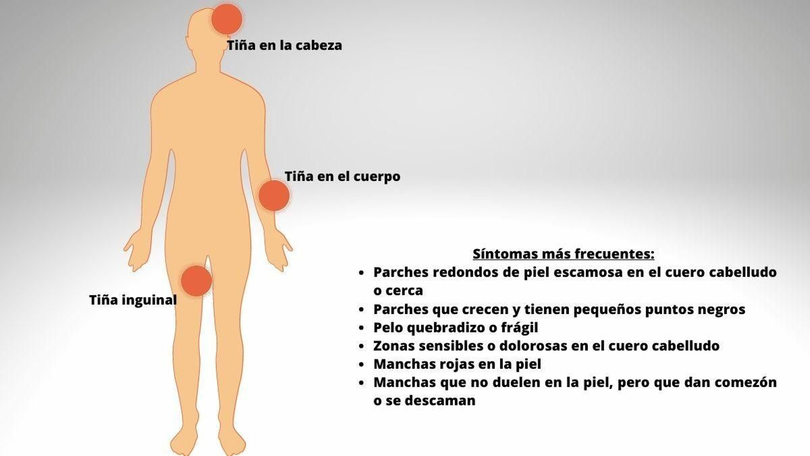 Partes que pueden verse afectadas por la tiña y síntomas frecuentes